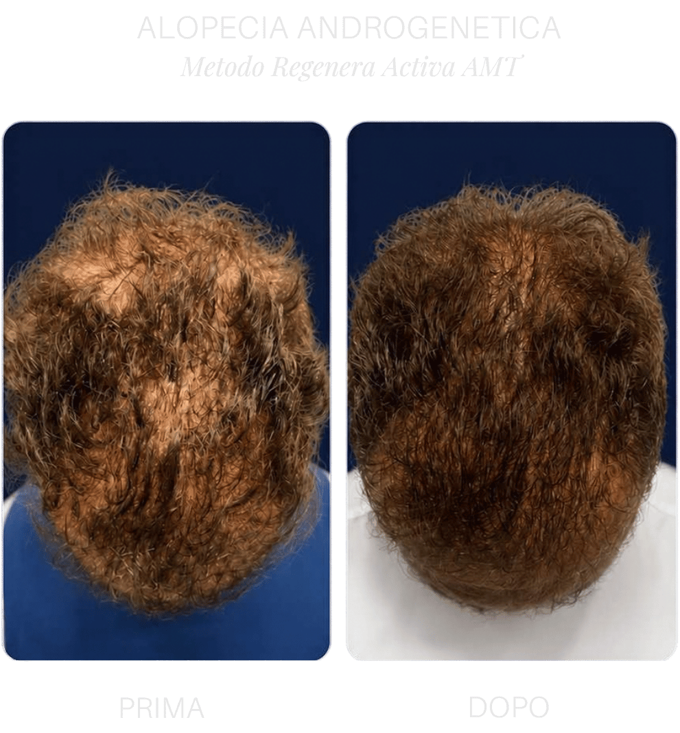 alopecia-androgenetica-ancona alopecia-androgenetica-ancona