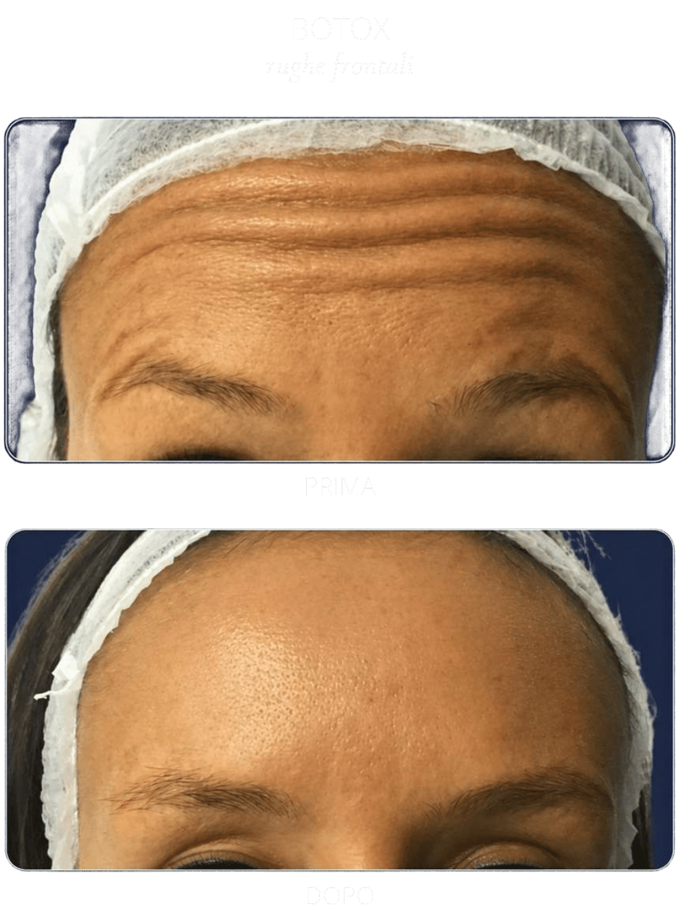 botox-rughe-frontali botox-rughe-frontali