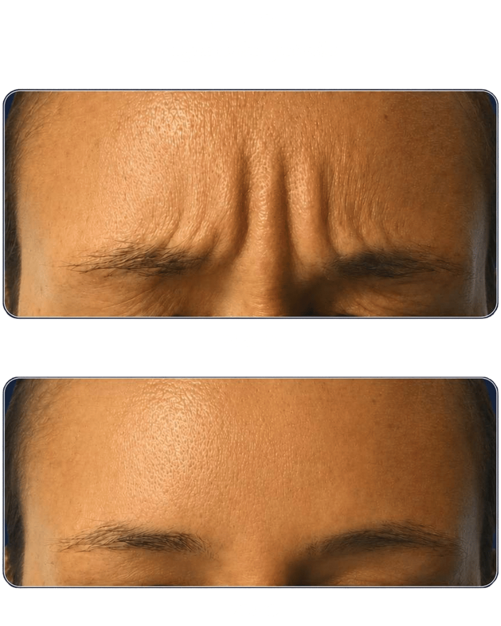 botox-rughe-glabella botox-rughe-glabella