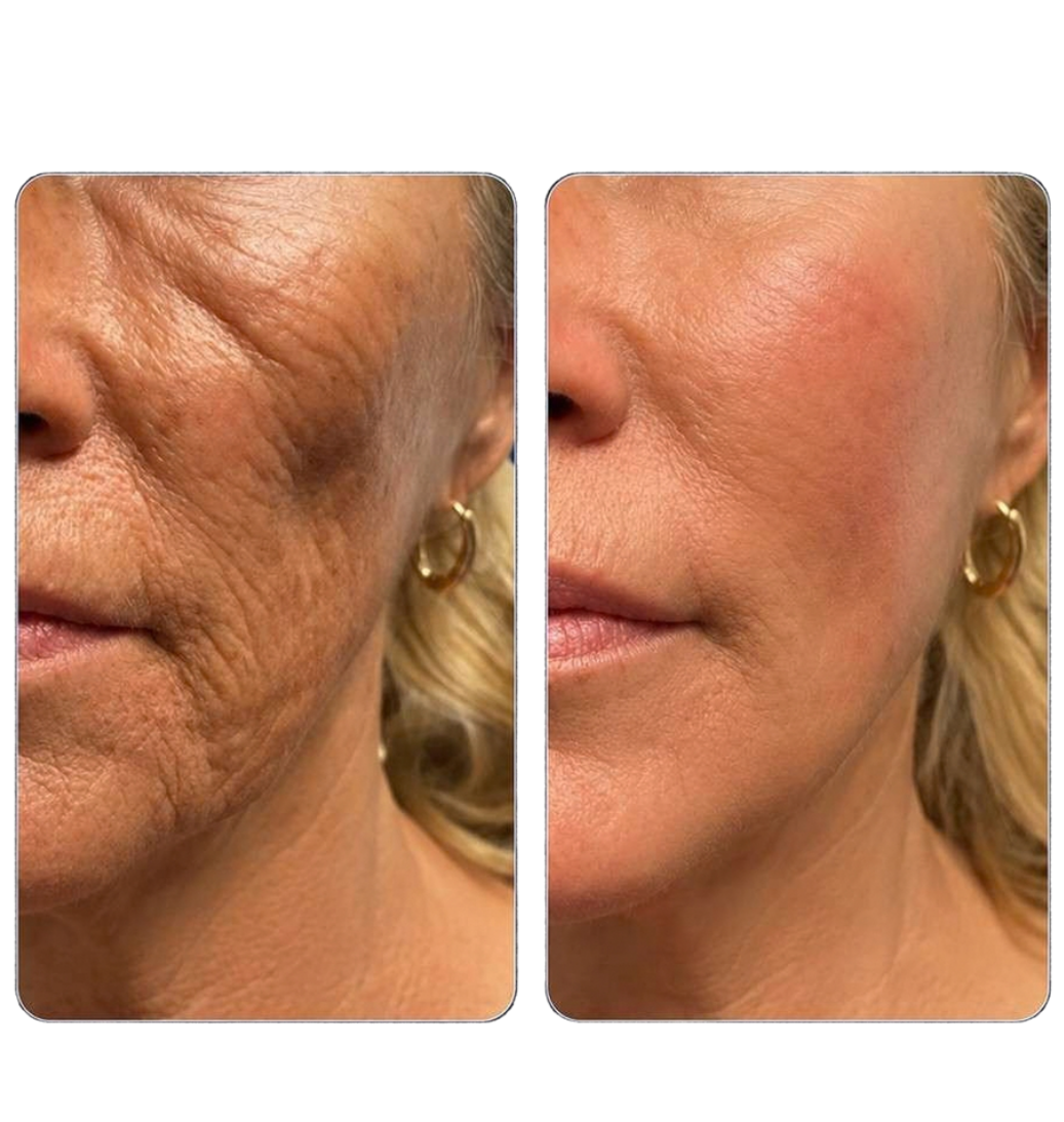 filler-guance filler-guance