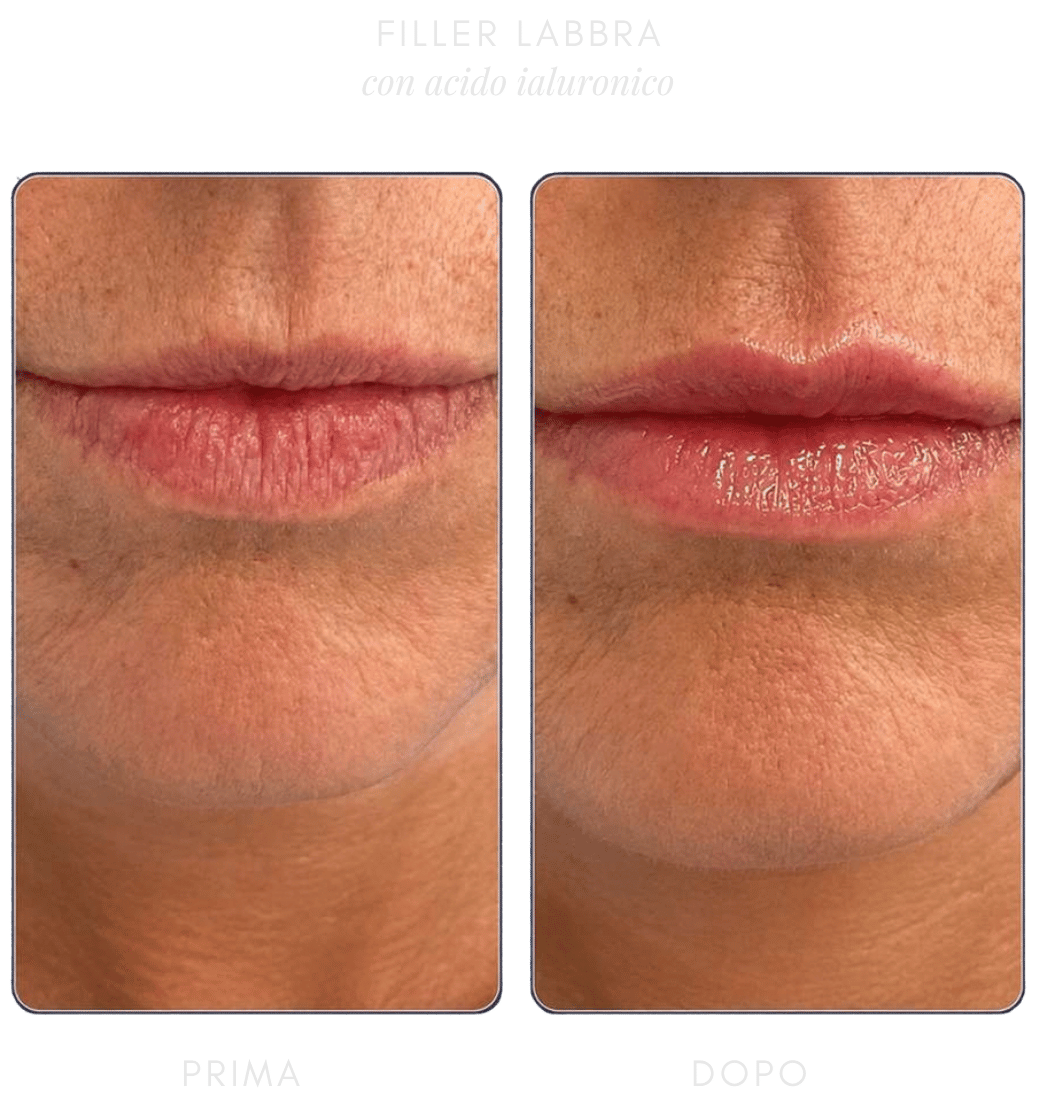 filler-ialuronico-labbra filler-ialuronico-labbra