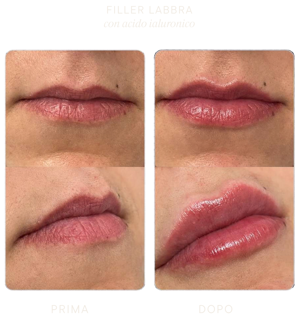 filler-labbra filler-labbra