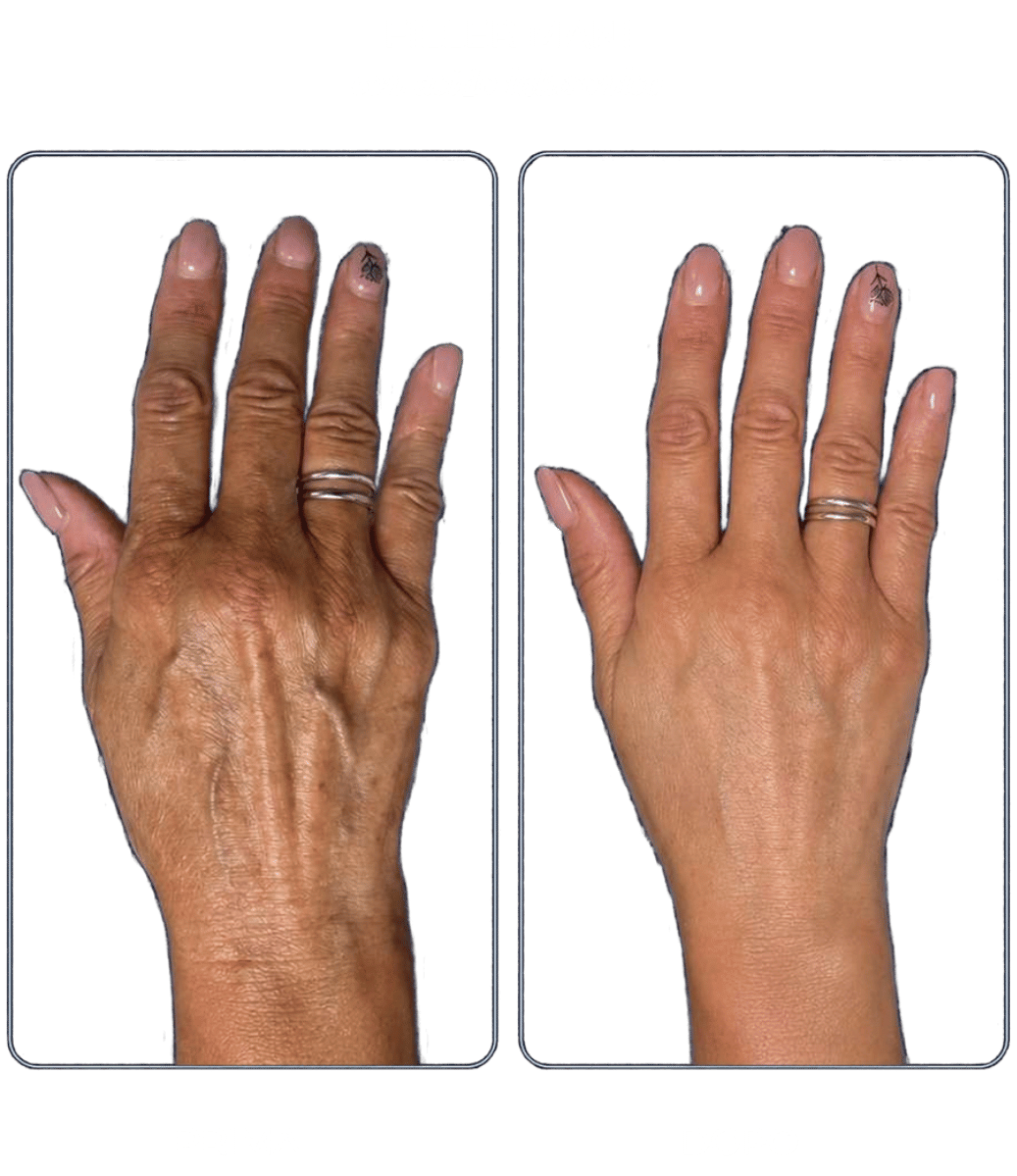 filler-mani filler-mani