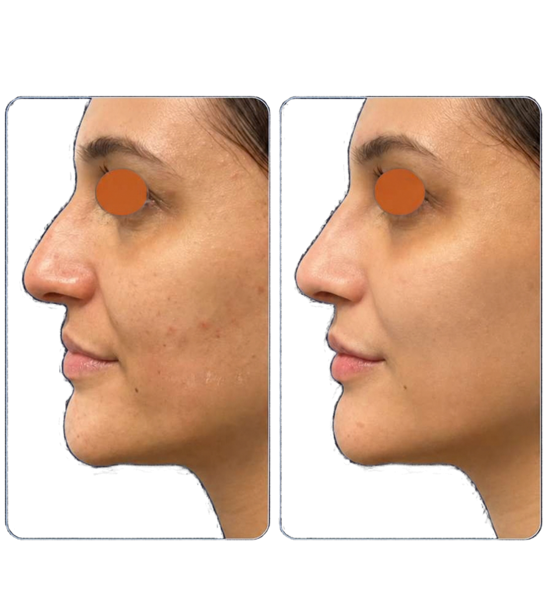 filler-viso filler-viso