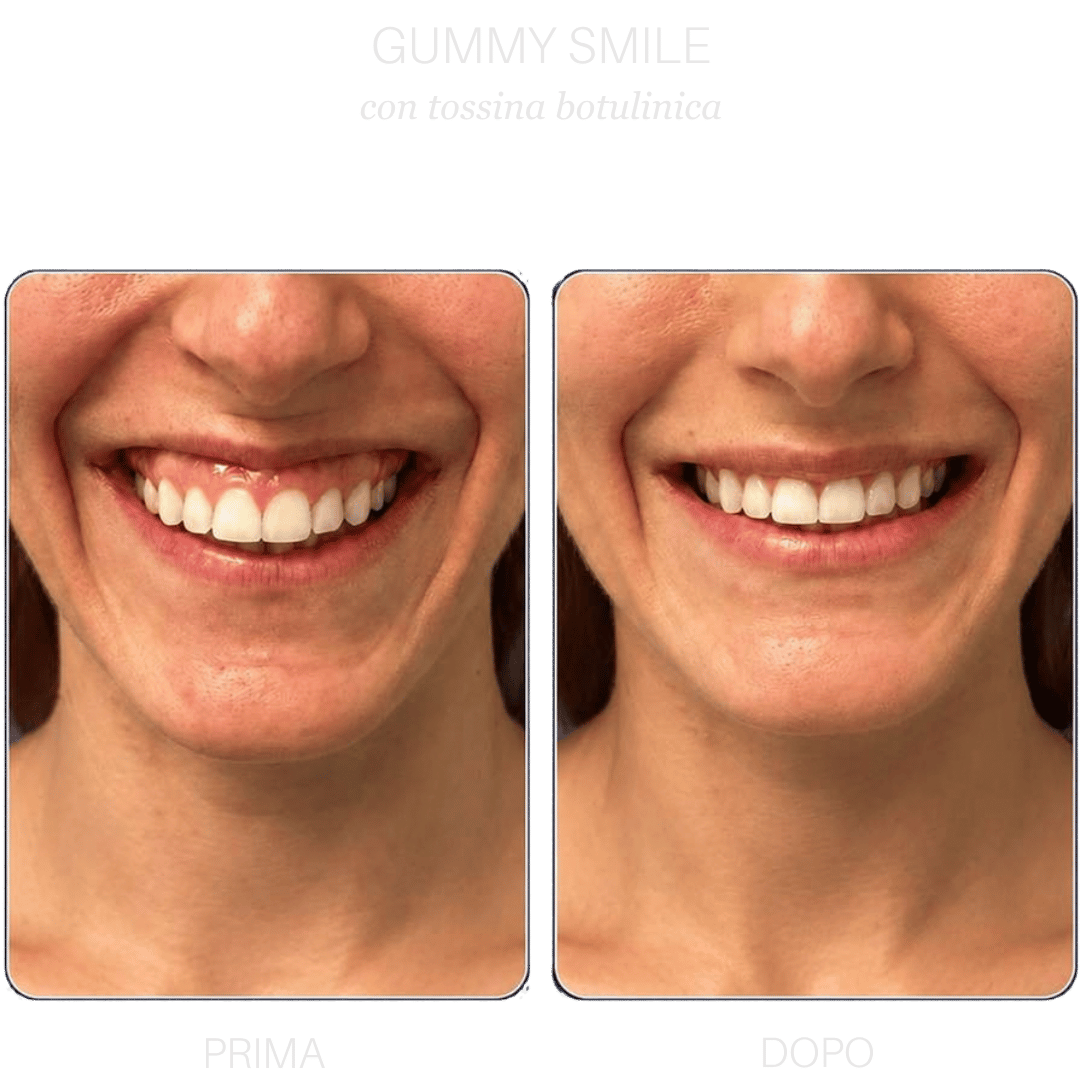 gummy-smile-botox-ancona gummy-smile-botox-ancona