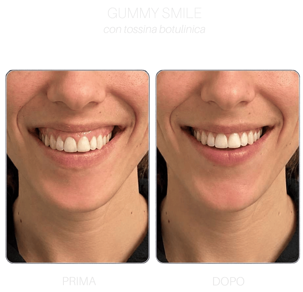 gummy-smile gummy-smile