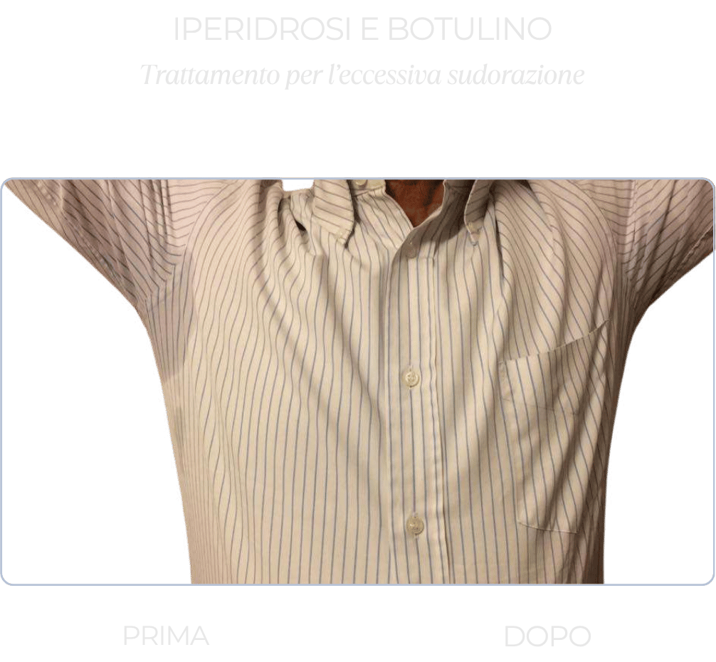 iperidrosi-botulino-sudorazione iperidrosi-botulino-sudorazione
