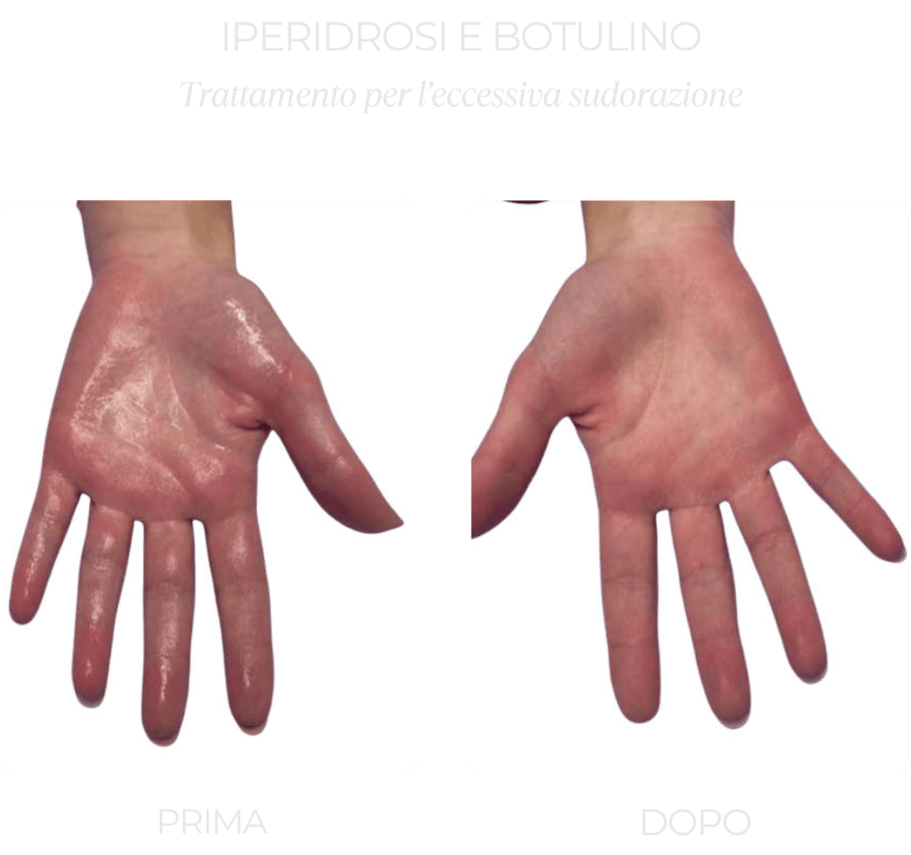 iperidrosi-mani-botox iperidrosi-mani-botox