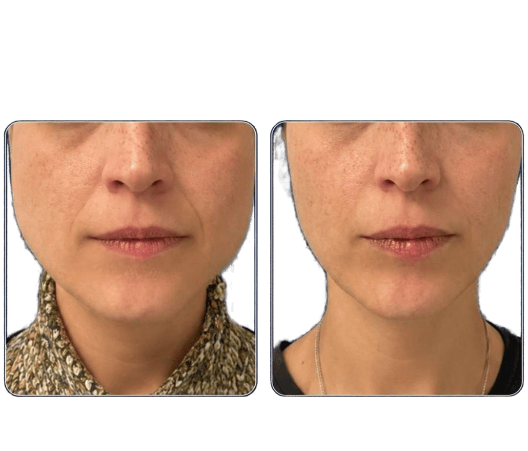 ipertrofia-massetere-botulino ipertrofia-massetere-botulino
