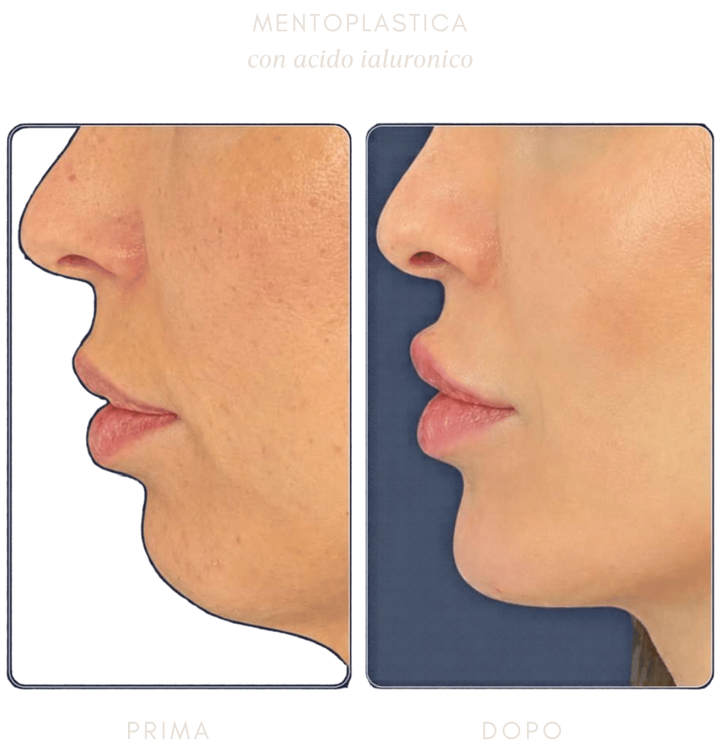 mentoplastica-filler mentoplastica-filler