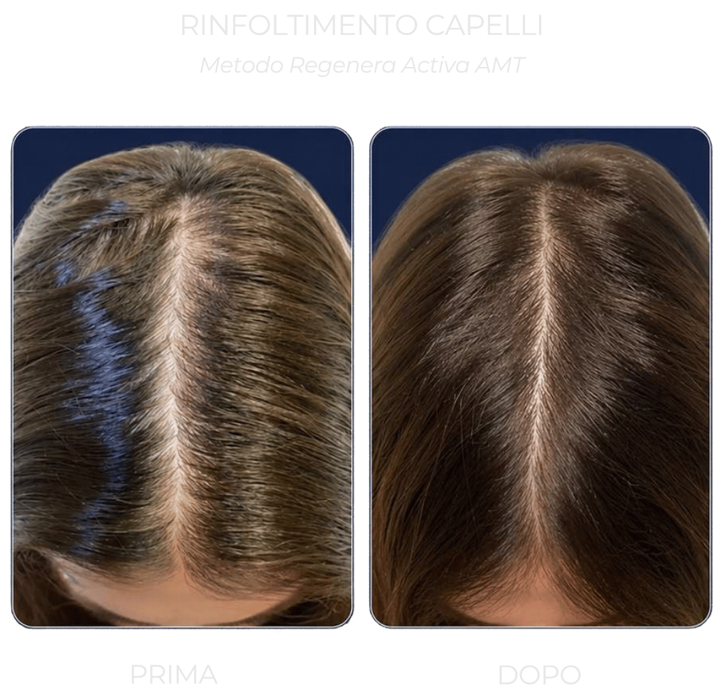 rinfoltimento-capelli-regenera-activa-amt rinfoltimento-capelli-regenera-activa-amt